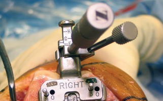 صورة طبية: استبدال مفصل الركبة بالحد الأدنى من التدخل الجراحي: ألم أقل وتعافٍ أسرع مع النهج شبه الرضفي الإنسي