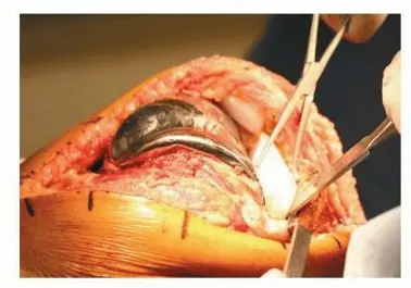 جراحة مراجعة مفصل الركبة: تقنيات آمنة لإزالة المكونات الثابتة واستعادة الحركة مع الأستاذ الدكتور محمد هطيف في صنعاء