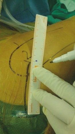 Illustration 2 for Mastering Direct Anterior Approach Hip Arthroplasty Without a Traction Table