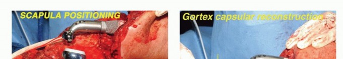Illustration 9 for Mastering Total Scapular Resections: Reconstruction & Outcomes