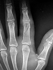 صورة طبية: دليل الأستاذ الدكتور محمد هطيف الشامل لأمراض وإصابات اليد والمعصم في صنعاء