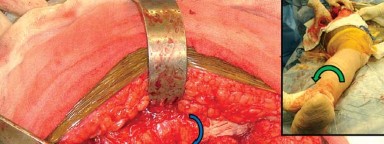 صورة طبية: إتقان توازن الأنسجة الرخوة لمفصل ورك صناعي مثالي: دليل شامل للمرضى مع الأستاذ الدكتور محمد هطيف