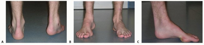 Illustration 48 for How Achilles Tendon Lengthening Fixes Equinocavovarus Foot