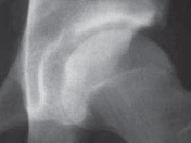 Illustration 25 for Resolving Femoral Head Neck Impingement: Arthroscopic FAI Solutions