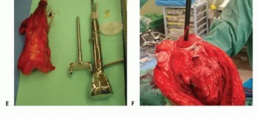 Illustration 9 for Expandable Prostheses: Understanding Infection Risk for Young Patients