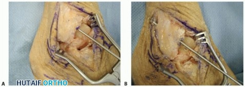 Illustration 11 for Lateral Ankle Repair: Maximize Stability with Interference Screw Fixation