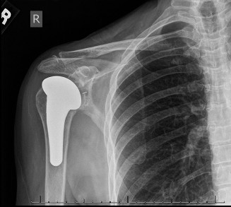 Illustration 25 for Right Shoulder Pain? Avoid This Common X-ray Mistake.