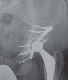 Illustration 66 for Navigating Early THA for Fractures of the Acetabulum