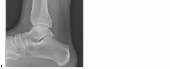 Illustration 2 for Painful Talus Lesions? The tech fig c Osteochondral Transfer Solution