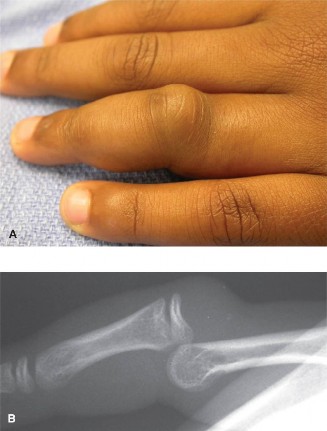 Illustration of dislocation of the pip - Dr. Mohammed Hutaif