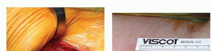 Illustration 42 for Anterior FAI Relief: Mini-Open Anterior Approach Explained