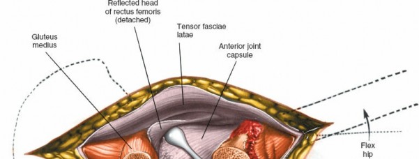 Illustration 118 for Unlocking Every Aspect of the Hip's Surgical Approaches