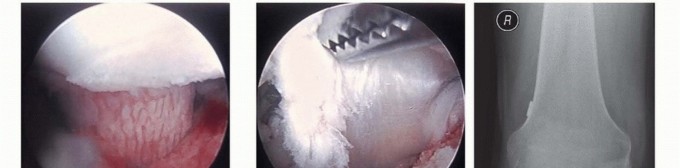 Illustration 24 for Posterior Cruciate Ligament Surgery: Regain Knee Strength & Stability