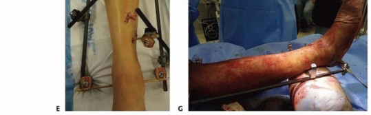 Illustration 53 for Tibia External Fixation: See How Pins Are Placed for Healing
