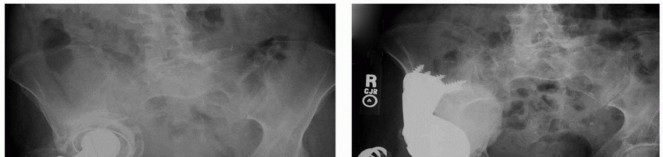 Illustration 6 for Custom Triflanged Devices: Solving Massive Acetabular Bone Loss
