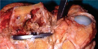 Illustration 8 for The Principles of Revision TKR: Avoid Pitfalls, Ensure Success