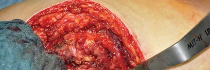 Illustration 52 for Collum Femoris Preserving: Achieve Better Primary Hip Outcomes