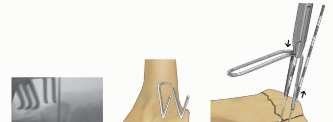 Illustration 40 for Fragment-Specific Fixation: Restore Carpal Facet Horizon