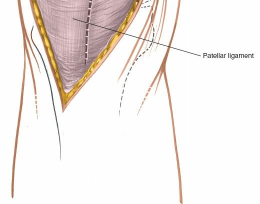 Illustration 34 for Mastering Knee Approaches: Spotlight on Superficial Medial Ligament