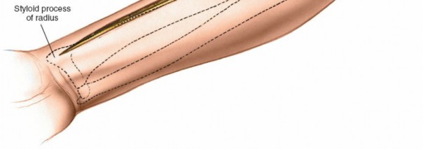 Illustration 3 for Radius Anterior Approach: Safe Nerve Protection & Complete Exposure