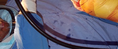 Illustration 28 for Mastering Gap Balancing in Revision TKA: Avoid Common Pitfalls