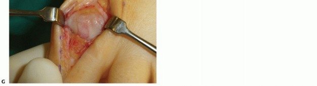 Illustration 22 for Mastering Extensive Plantar Release for Hallux Rigidus