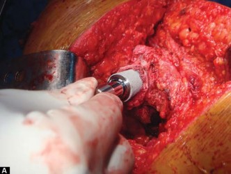 Illustration 62 for The Silent Hip: Achieving a Truly Silent, Pain-Free Joint