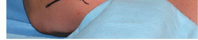 Illustration 27 for Is Your Dorsal Scapular Nerve Causing Snapping Scapula Pain?