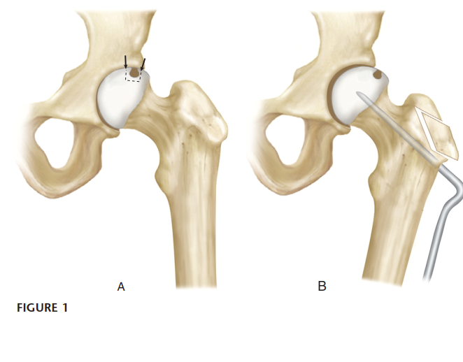 Intertrochanteric Femoral Osteotomy: Indications for Hip Preservation