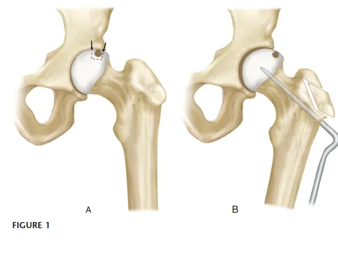 قطع عظم الفخذ بين المدورين: حلول متقدمة للحفاظ على مفصل الورك في صنعاء