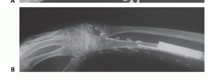 Illustration 42 for Free Vascularized Fibular Grafts: Solving Complex Bone Defects