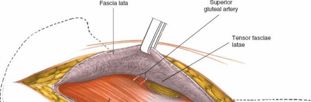 Illustration 105 for Unlocking Every Aspect of the Hip's Surgical Approaches