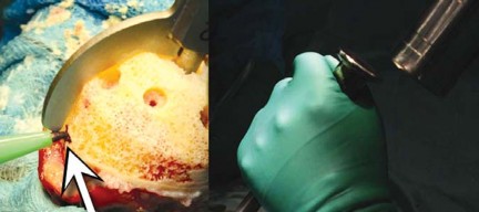 Illustration 100 for Birmingham Hip Resurfacing Designer's Technique for Active Lives