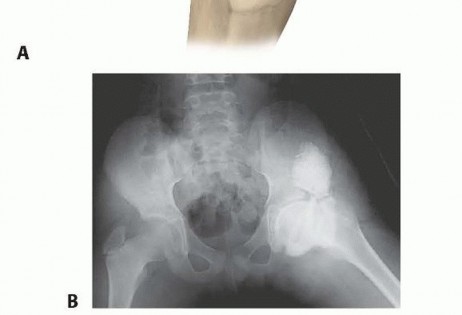 Illustration 12 for Labral Support Shelf Procedure: Preventing Perthes Deformity