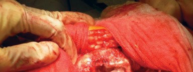 Illustration 18 for Cemented Femoral Stem Figures: Surgical Anatomy & Placement