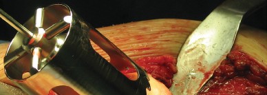 Illustration 36 for Figure Hip Resurfacing: Who Benefits and Who Should Avoid It?