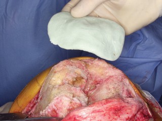 Illustration 29 for PROSTALAC Articulating Spacer: Treat Infected Knees, Regain Mobility