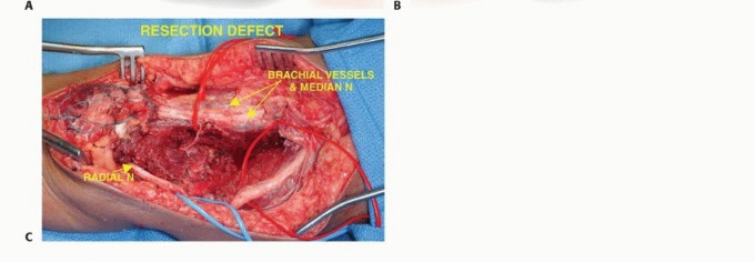 Illustration 17 for Distal Humeral Resection: Safe Techniques for Limb Preservation