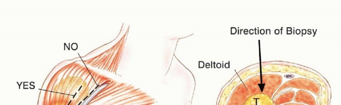 Illustration 10 for Limb-Sparing Resections Around the Shoulder: Optimizing Outcomes
