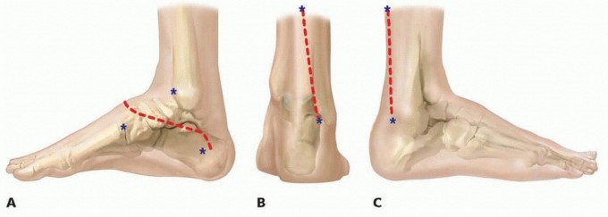 Illustration 6 for Resistant Clubfoot Solved: Posteromedial and Posterolateral Release