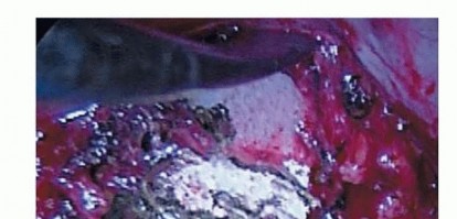 Illustration 15 for Anterior Interbody Arthrodesis for Scoliosis: What You Need to Know