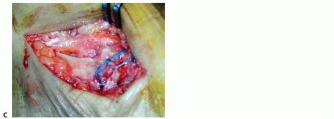 Illustration 52 for Medial Ankle Instability: Find Relief with Reconstruction