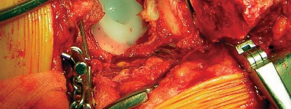 Illustration 63 for Cemented Component Longevity: The Critical Margin of the Acetabulum