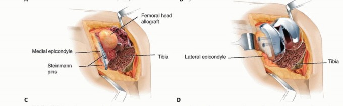 Illustration 13 for Femoral Bone Loss: Metal Augments for Revision Knee Success