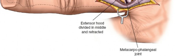 Illustration 4 for Unlock Easier Access: Dorsal Approach for Phalanges and Interphalangeal Joints