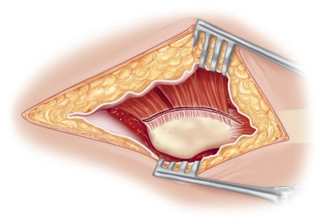 Illustration 2 for Mastering Direct Lateral Exposure for Revision Total Hip Success
