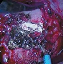 Illustration 21 for Mastering Anterior Interbody Arthrodesis with Instrumentation for Scoliosis