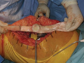 Illustration 12 for Extensor Reconstruction in Total Knee Arthroplasty: Essential Strategies