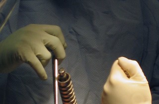 Illustration 15 for Posterior Stabilized Technique: Essential Insights for TKA Success