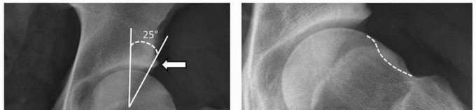 Illustration 8 for Beyond Knee Surg: Hip Arthroscopy for Sports Injuries